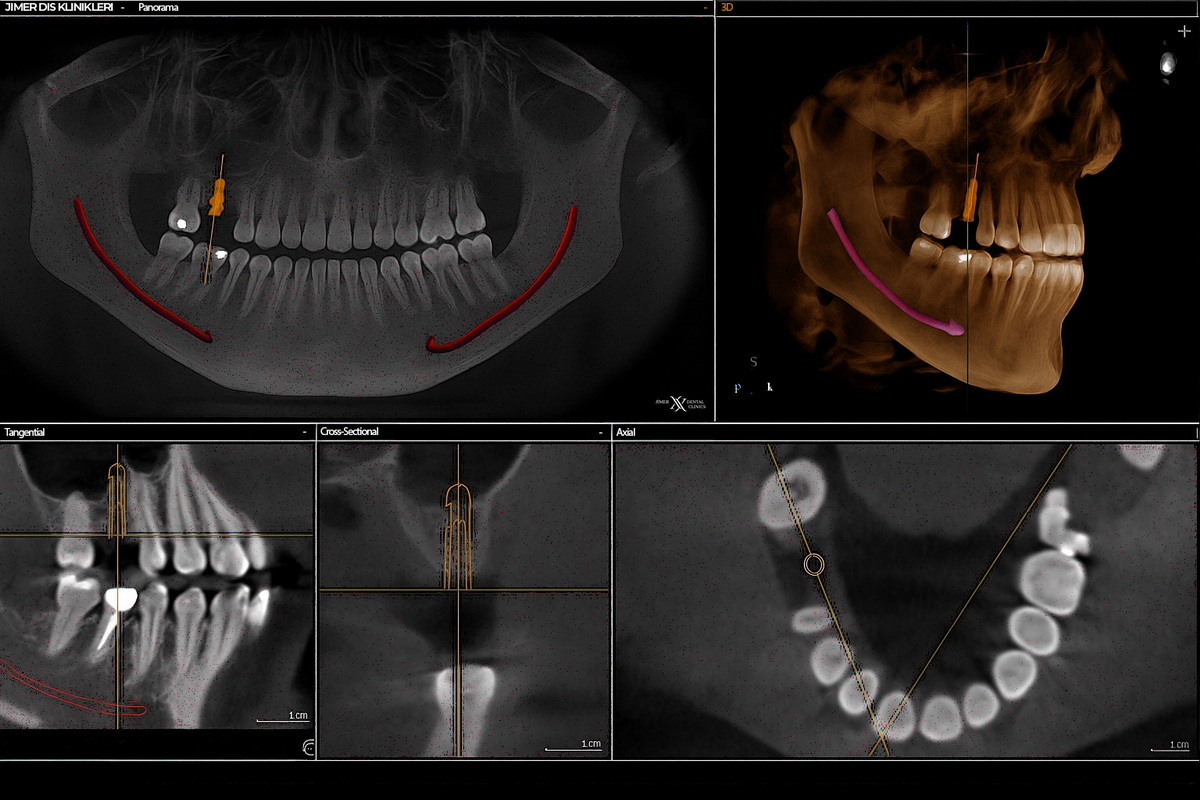 Einsatzmöglichkeiten der Dentaltomographie